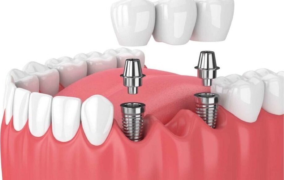 Dental Implant