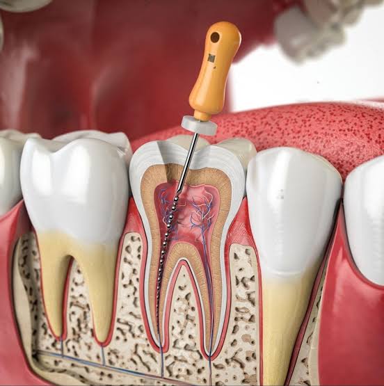 Root canal