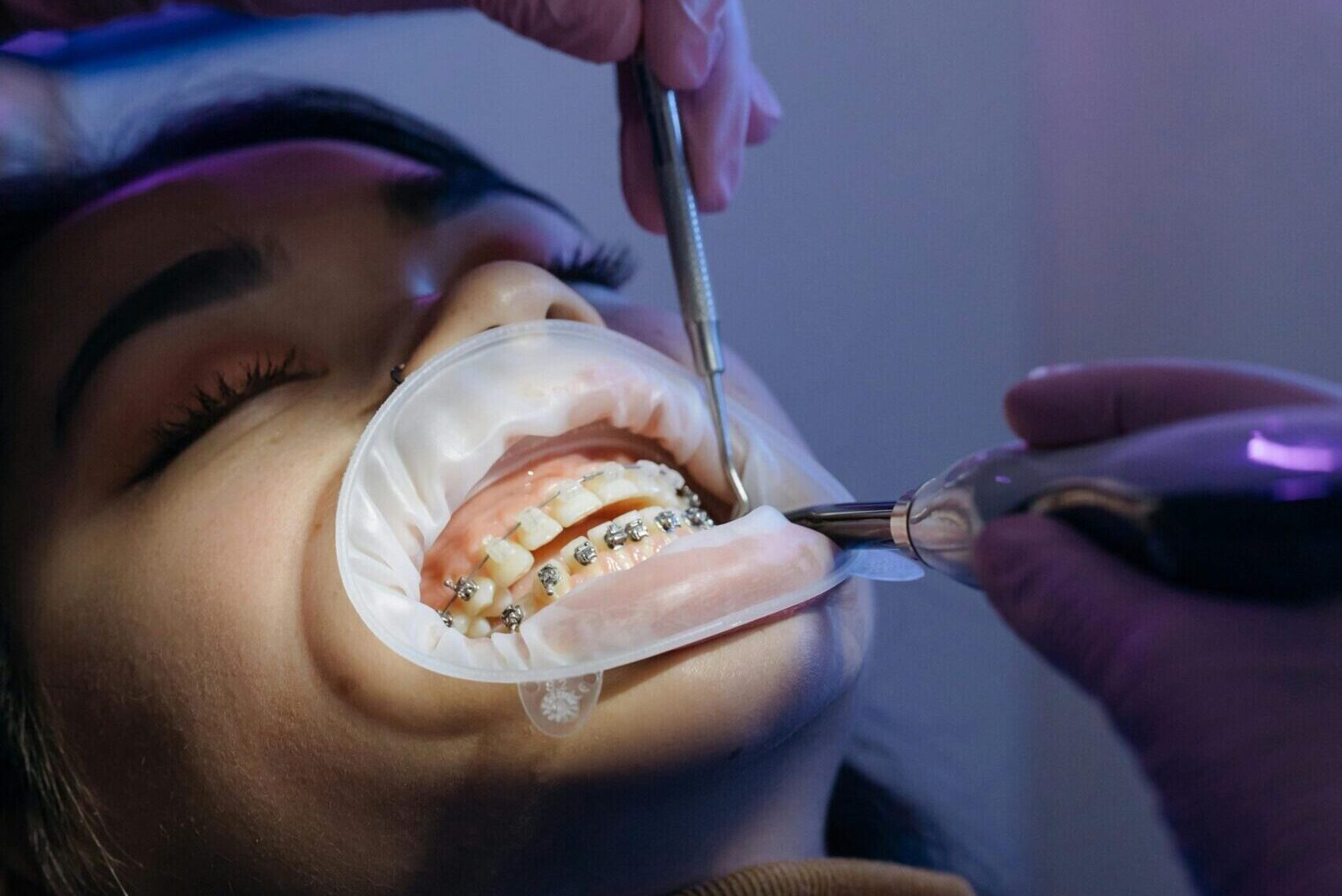 Root canal